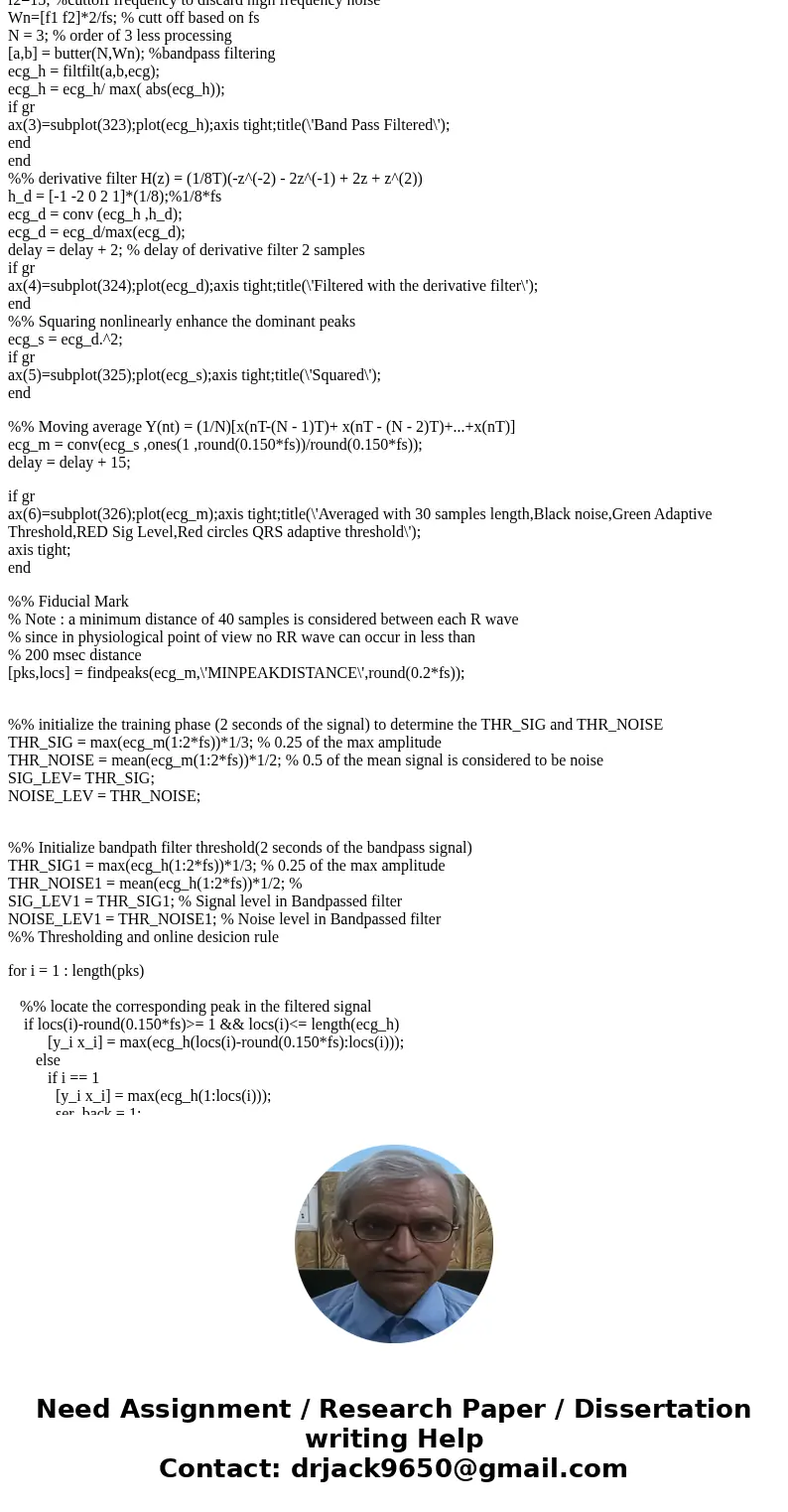 I need help understanding the Pan Tompkins algorythm, and I\'d also like to know how to detect QRS peaks of the ECG (with circles, for example). I\'m using the  I need help understanding the Pan Tompkins algorythm, and I\'d also like to know how to detect QRS peaks of the ECG (with circles, for example). I\'m using the